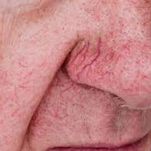 rozšířené žilky na nose u muže