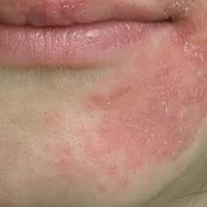 periorální dermatitida